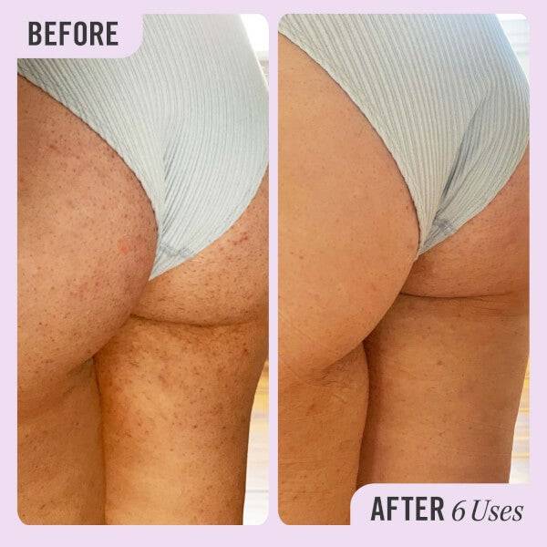 First Aid Beauty KP Bump Eraser Body Scrub With 10% AHA 56.7g