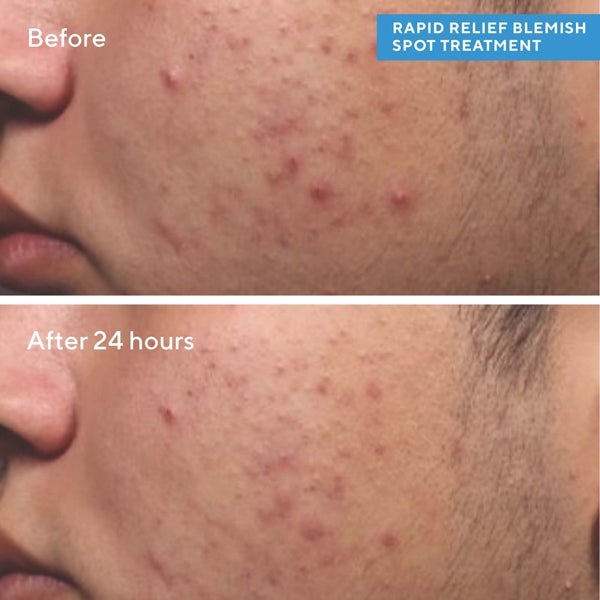 Murad Rapid Relief Spot Treatment