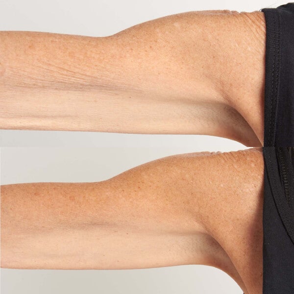 Perricone MD HP Hyaluronic Intensive Body Therapy 6 Oz FG