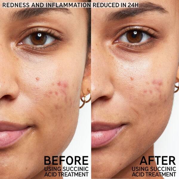The INKEY List Succinic Acid Blemish Treatment 15ml