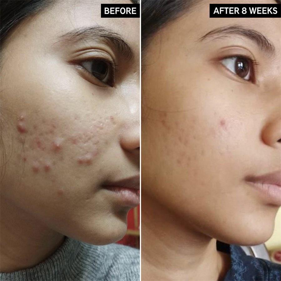 Reiniger Salicylic Acid Cleanser Von The INKEY List