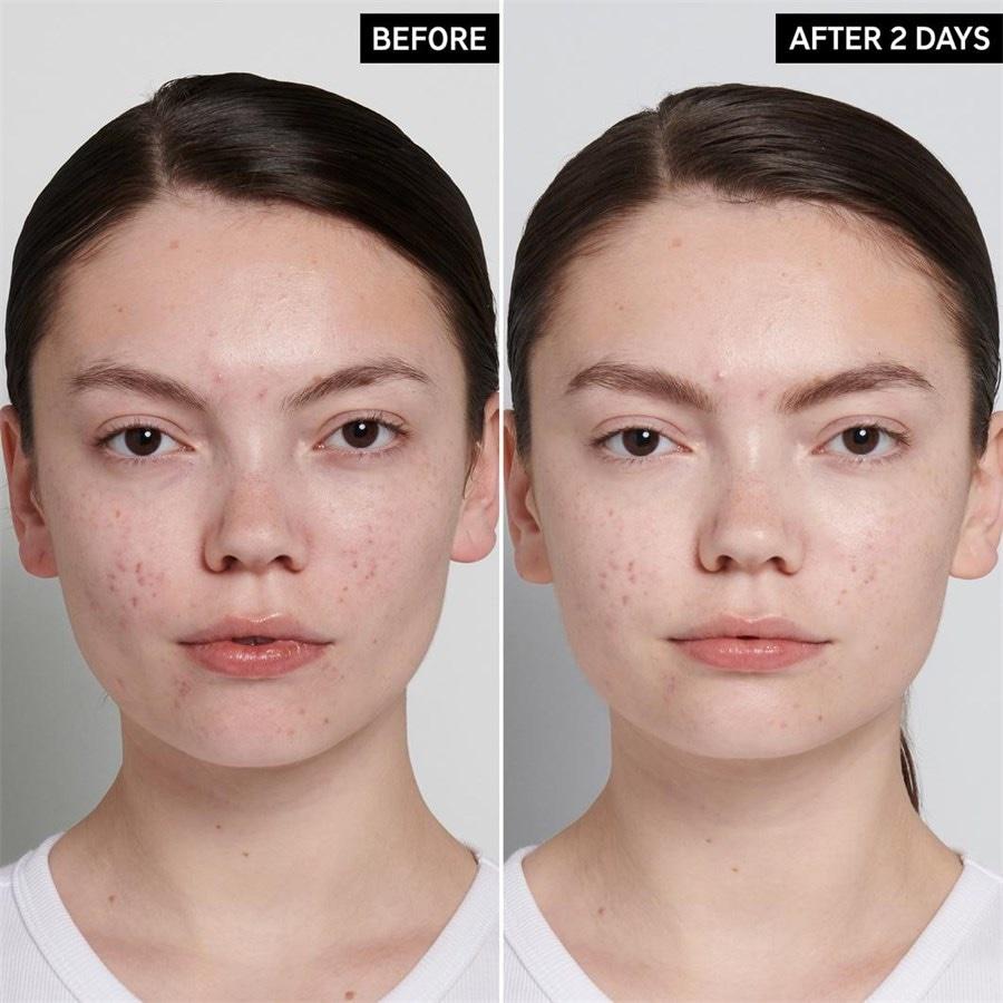The INKEY List Succinic Acid Treatment