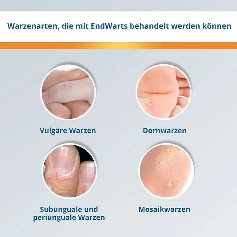 Shopapotheke EndWarts CLASSIC: Lösung Mit Ameisensäure Gegen Warzen Und Dornwarzen Warzenbehandlung Für Hände Und Füße