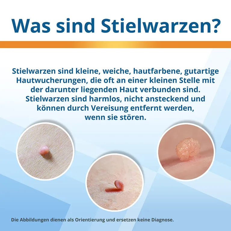 Shopapotheke EndWarts EXTRA: Stielwarzen Entfernen Vereisungsmittel Zur Entfernung Von Stielwarzen An Hals Brust & Achseln