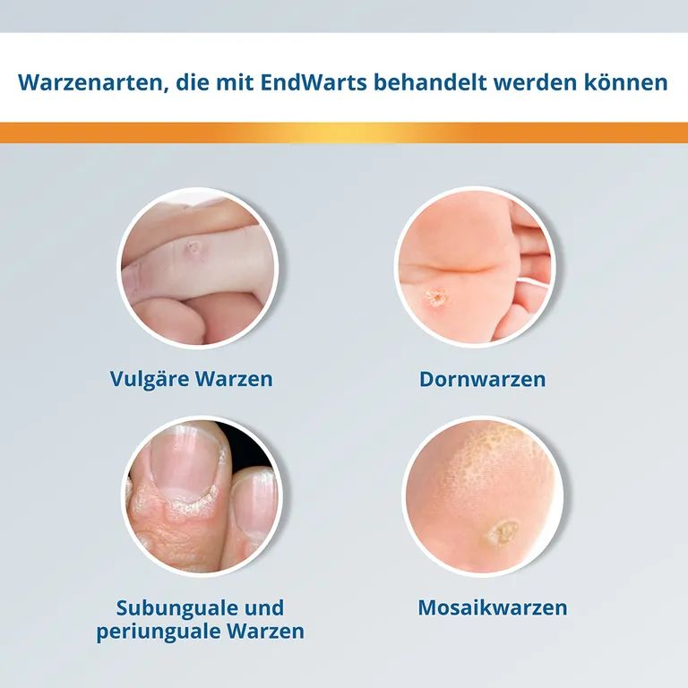 Shopapotheke EndWarts FREEZE: Vereisungsmittel Zur Entfernung Von Warzen An Händen Armen & Füßen