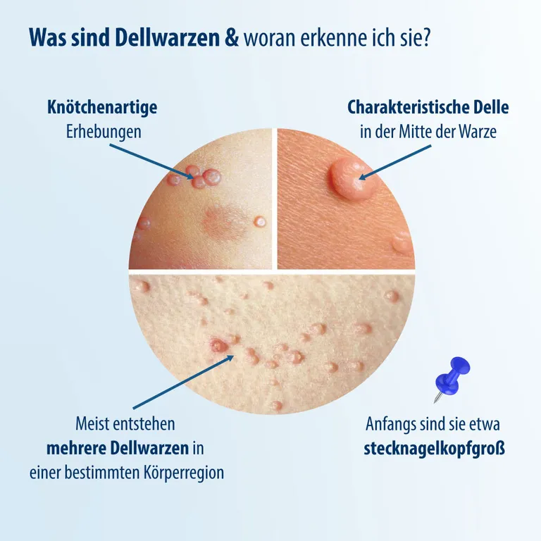 Shopapotheke Evolsin® Dellwarzen Mittel I Für Erwachsene & Kinder Ab 2 Jahren I Dellwarzen Behandlung Mit Ätzkali
