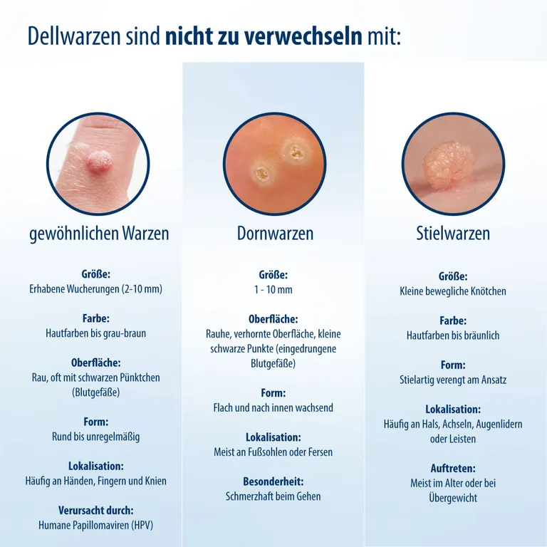 Shopapotheke Evolsin® Dellwarzen Mittel I Für Erwachsene & Kinder Ab 2 Jahren I Dellwarzen Behandlung Mit Ätzkali