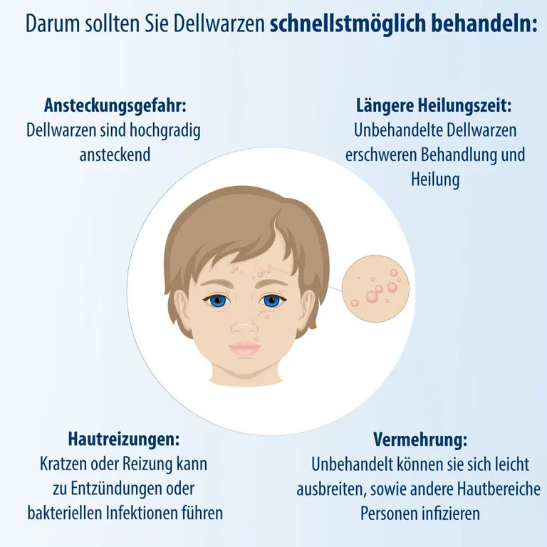 Shopapotheke Evolsin® Dellwarzen Mittel I Für Erwachsene & Kinder Ab 2 Jahren I Dellwarzen Behandlung Mit Ätzkali