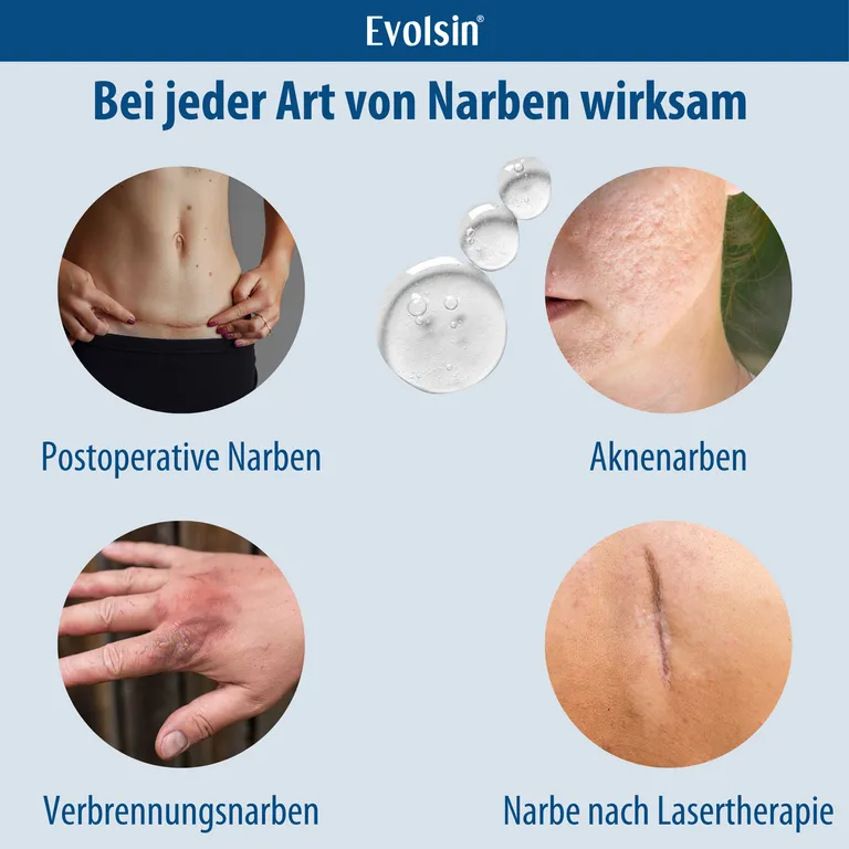 Shopapotheke Evolsin® Narbengel Für Kinder & Erwachsene – Narbensalbe Reduziert Die Sichtbarkeit Von Narben – Narbencreme Für Narben Aller Art
