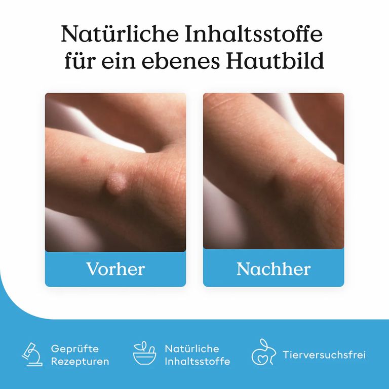 Shopapotheke Health Routine Wart Care Pen / Bei Warzen