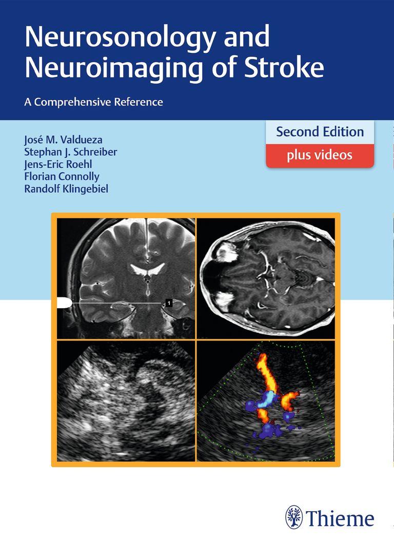 shopapotheke Neurosonology and Neuroimaging of Stroke