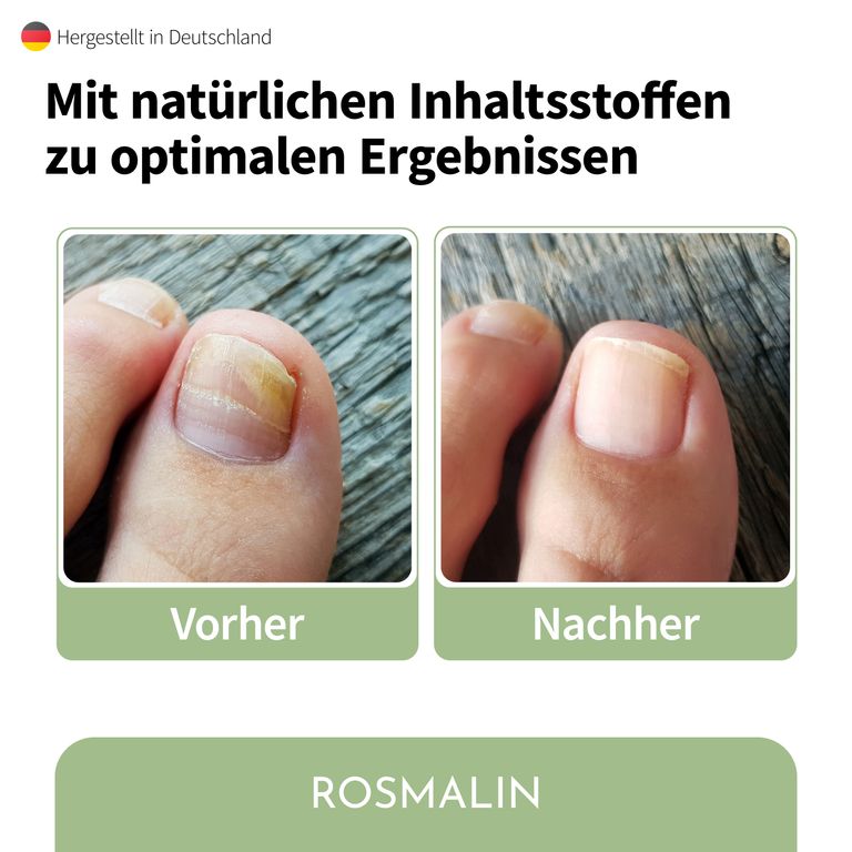 Shopapotheke Rosmalin® Nail Care Pen - Nagelpilz Pflege