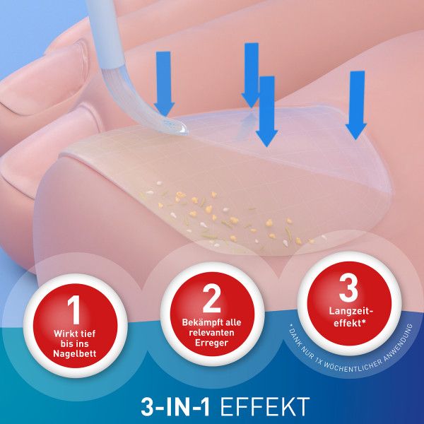 Bodyguardapotheke LOCERYL Nagellack Gegen Nagelpilz DIREKT-Applikat