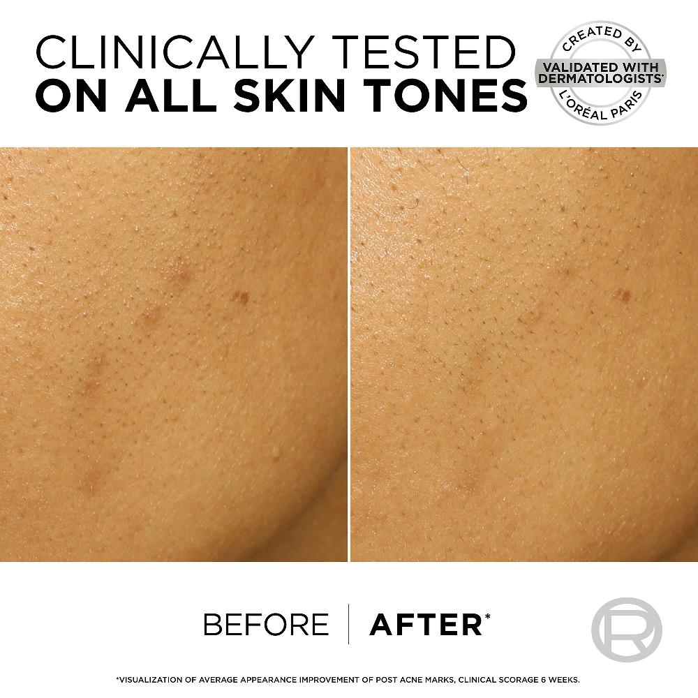 Lookfantastic L'Oréal Paris Bright Reveal Dunkle-Flecken-Peeling Für Das Gesicht 25 % AHA + BHA + Polyhydroxyalkanoate Und Nicotinamid 25 ml
