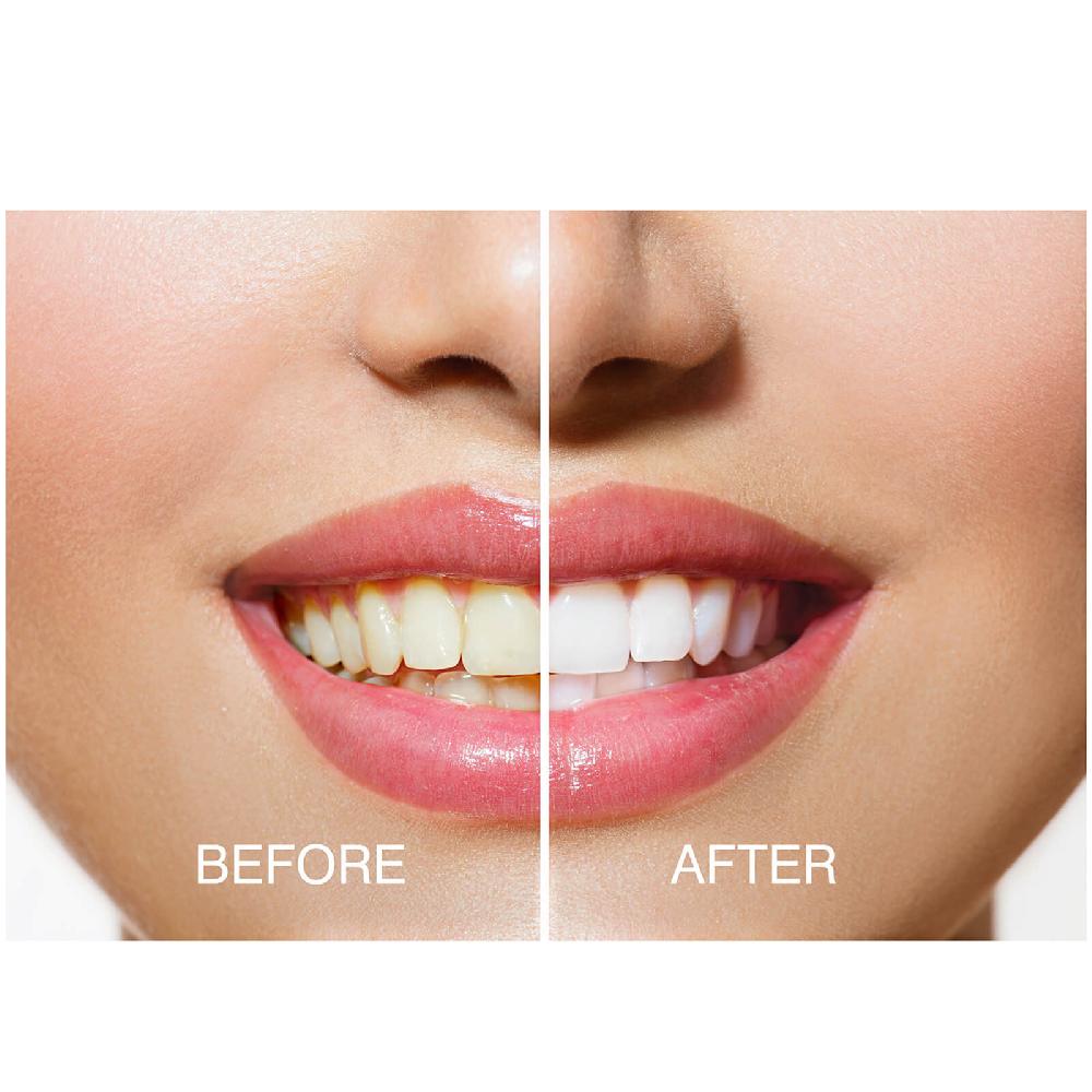 Lookfantastic Rio Smile White Advanced Zahnaufhellungs-Kit